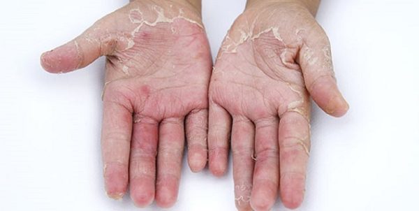 Natural Remedies For Peeling Hands That Are Really Effective