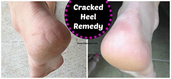 Excellent Remedies For Cracked Heels That Will Do Wonders For You