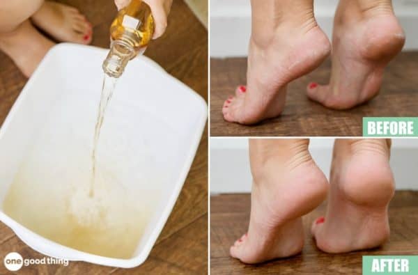 Excellent Remedies For Cracked Heels That Will Do Wonders For You