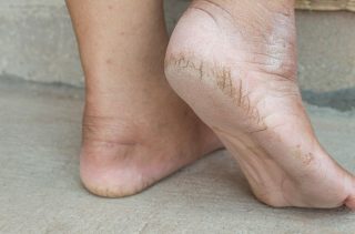 Excellent Remedies For Cracked Heels That Will Do Wonders For You