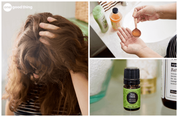 How To Get Rid Of Dandruff With These Natural Remedies