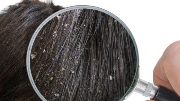 How To Get Rid Of Dandruff With These Natural Remedies