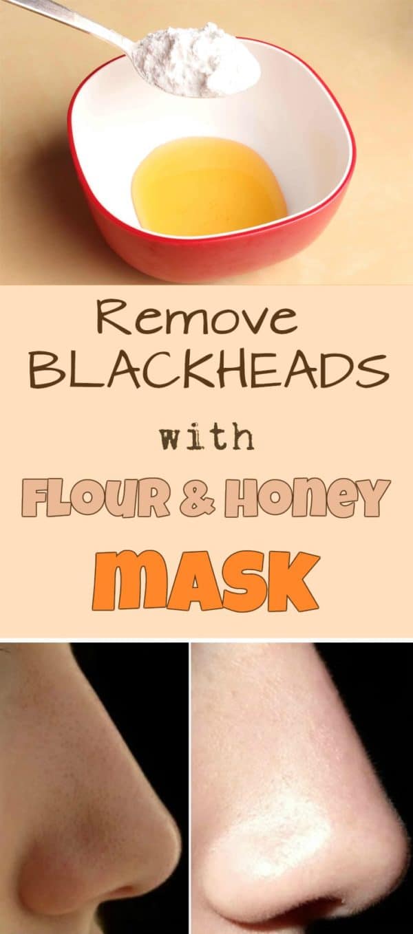 The Best Blackheads Remedies That You Can Make At Home In Just A Few Steps