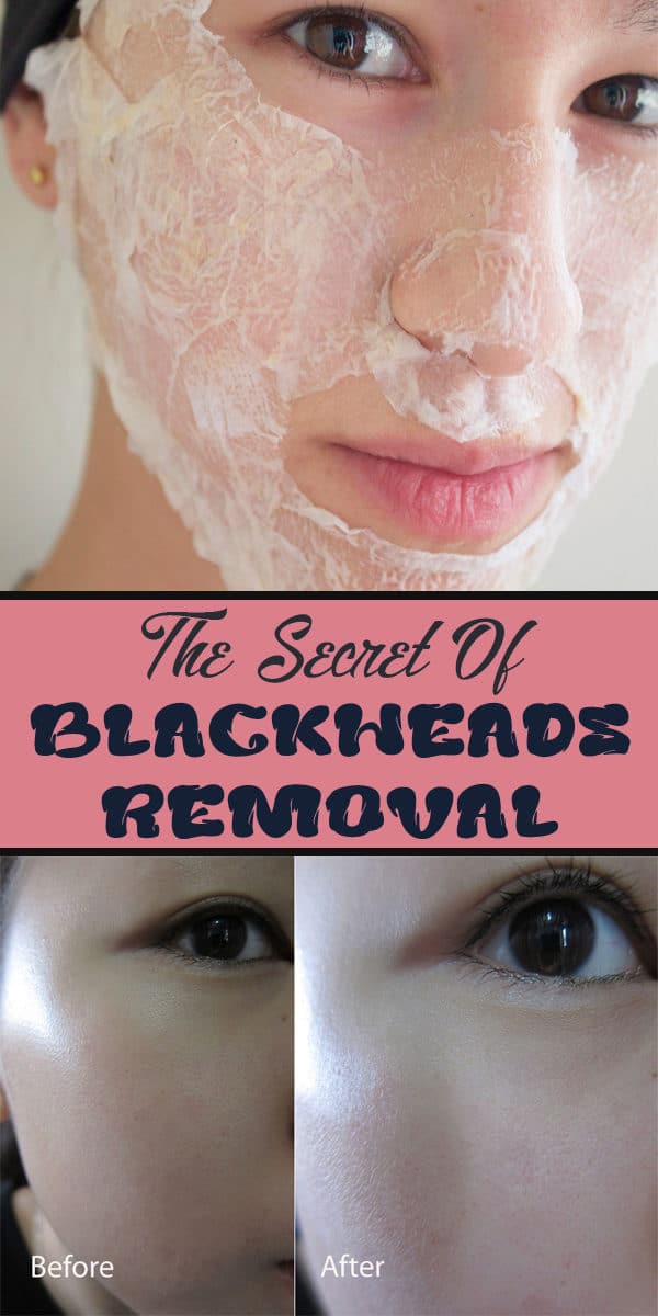 The Best Blackheads Remedies That You Can Make At Home In Just A Few Steps