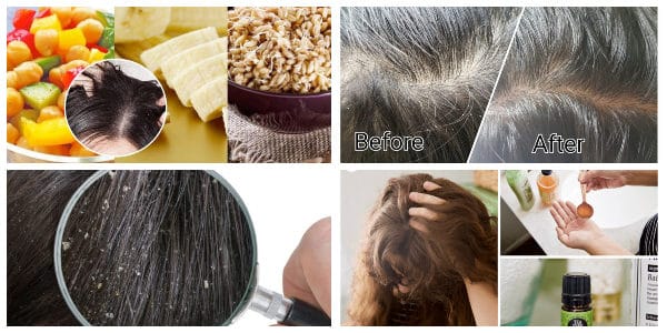 How To Get Rid Of Dandruff With These Natural Remedies