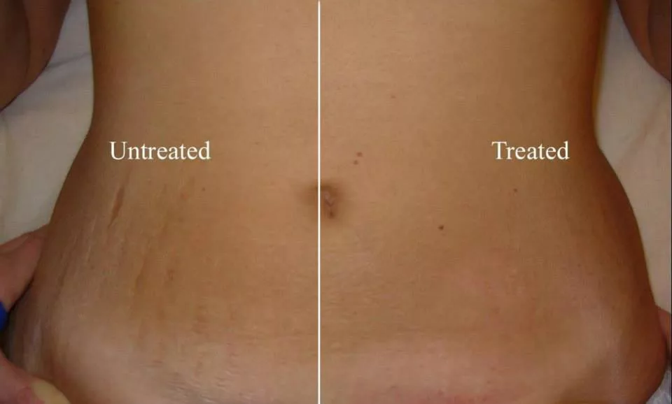 Natural Stretch Marks Remedies That Will Work Miracles On Your Skin