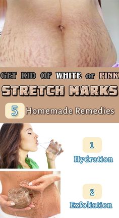 Natural Stretch Marks Remedies That Will Work Miracles On Your Skin