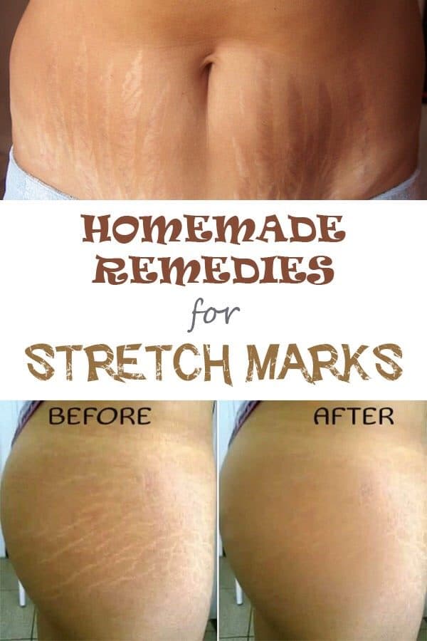 Natural Stretch Marks Remedies That Will Work Miracles On Your Skin