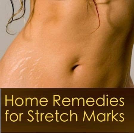 Natural Stretch Marks Remedies That Will Work Miracles On Your Skin