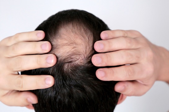 The Ultimate Treatments for Hair Loss