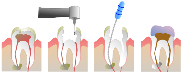 What Are The Costs Of Getting A Cavity Filled?