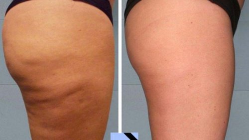 Homemade Anti Cellulite Treatments That  Are Really Effective