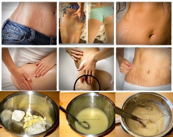 Homemade Stretchmarks Remedies That Are Really Effective And Easy To Make