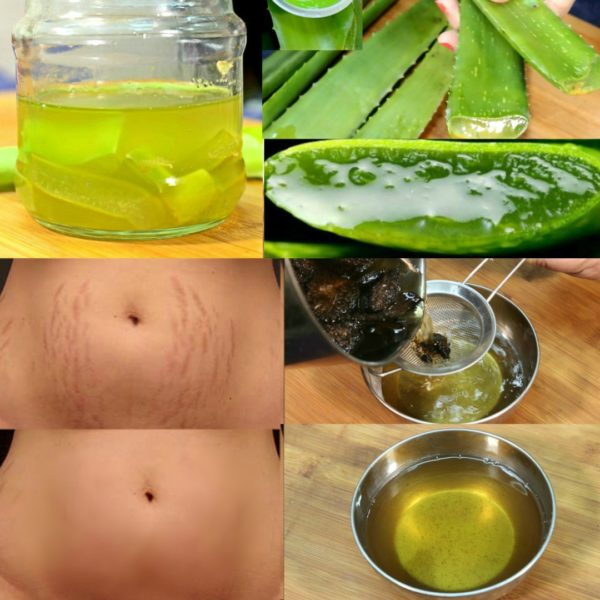 Homemade Stretchmarks Remedies That Are Really Effective And Easy To Make