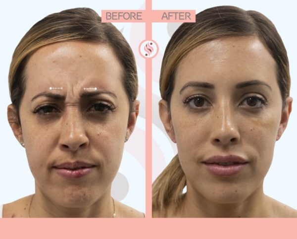 Why Choose Juvederm?