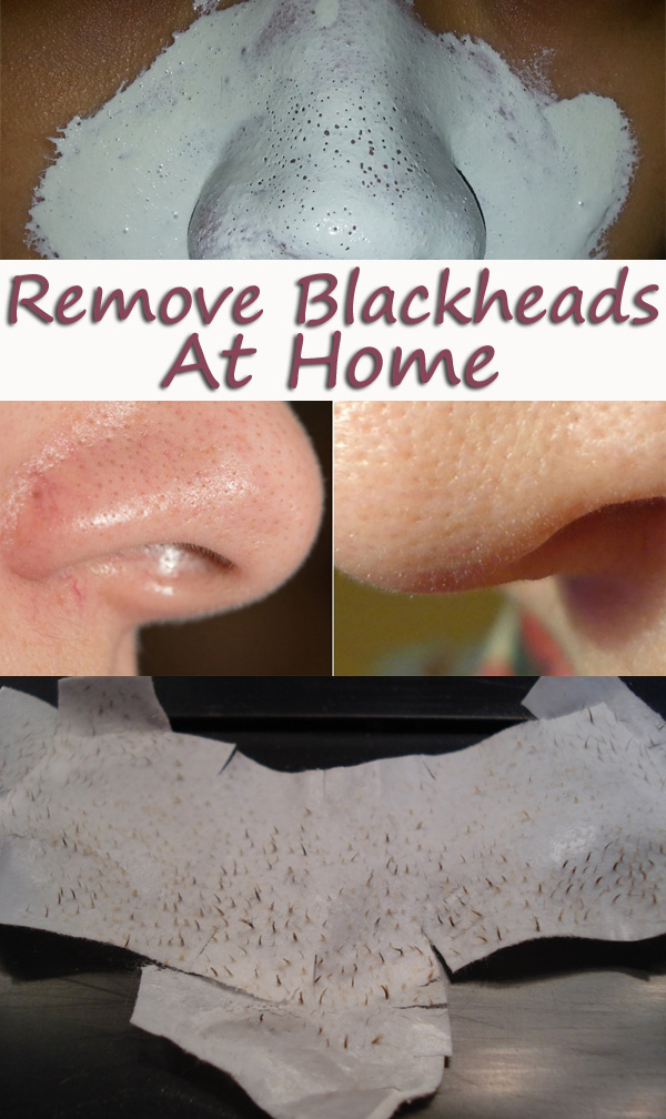 Effective Remedies That Will Help You Get Rid Of Blackheads Naturally