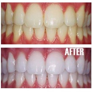 Revolutionary Teeth Whitening Remedies That Are Amazing For Your Yellow Teeth