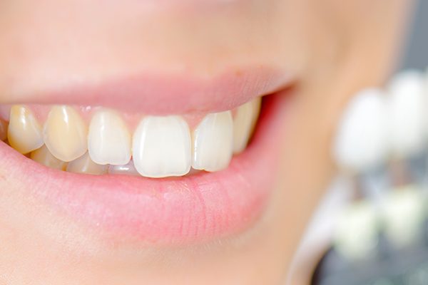 Revolutionary Teeth Whitening Remedies That Are Amazing For Your Yellow Teeth