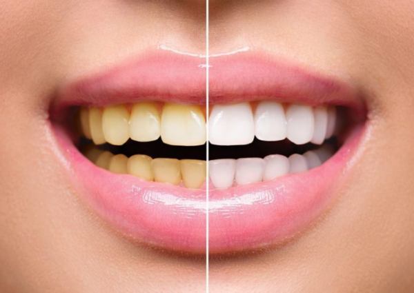 Revolutionary Teeth Whitening Remedies That Are Amazing For Your Yellow Teeth