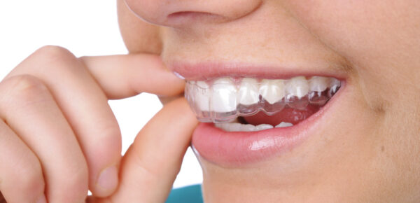 Tips for Picking the Best Invisible Braces