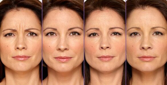 BOTOX® Cosmetic Pictures | Botox, Botox cosmetic, Botox injections