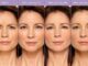 BOTOX® Cosmetic Pictures | Botox, Botox cosmetic, Botox injections