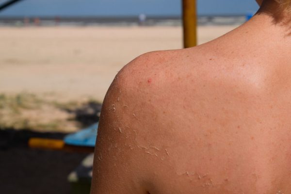 How To Treat Sunburn Naturally