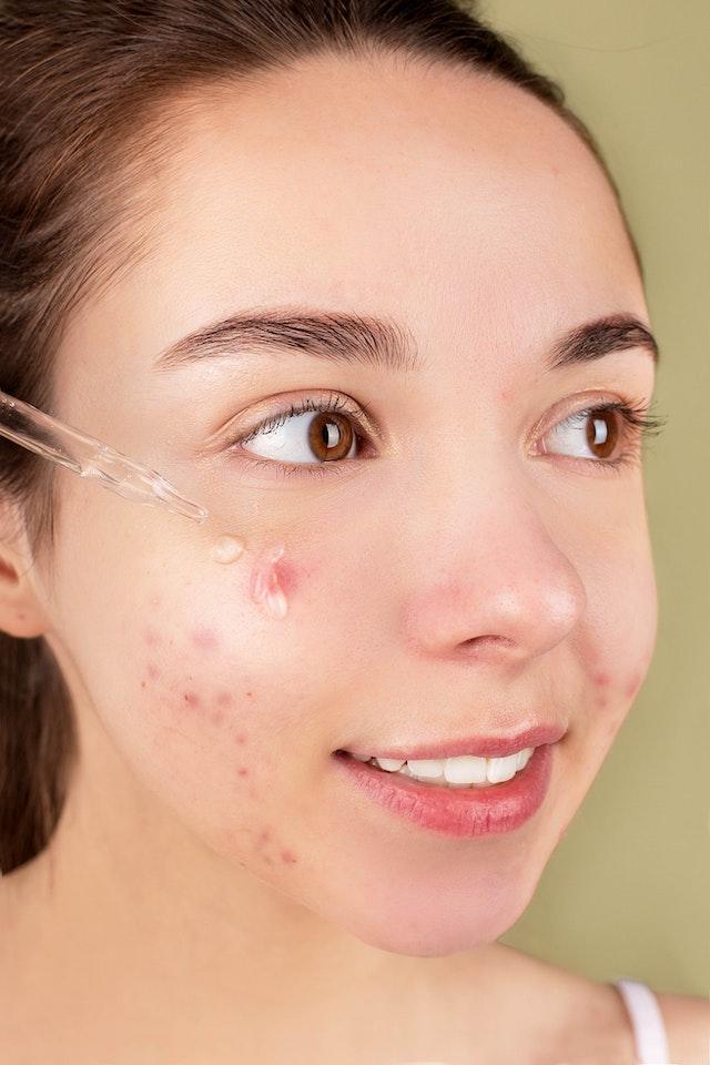 5 Skincare Routine Tips to Prevent and Treat Acne