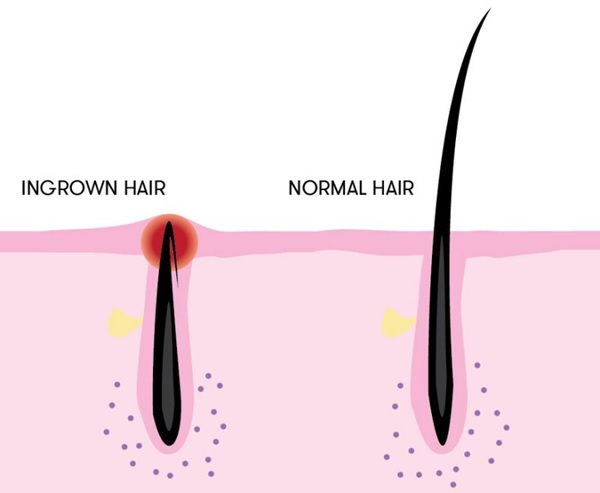 How to Get Rid of Ingrown Hairs   Tips and Tricks